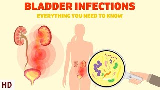 Bladder Infections: The Silent Epidemic Affecting Millions of Women!