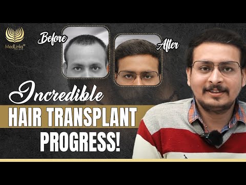 Hair Transformation at 3 Months | Incredible Hair Transplant Progress! | MedLinks