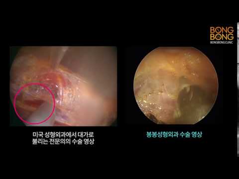 미국성형외과 유명전문의와 봉봉성형외과 수술영상 비교