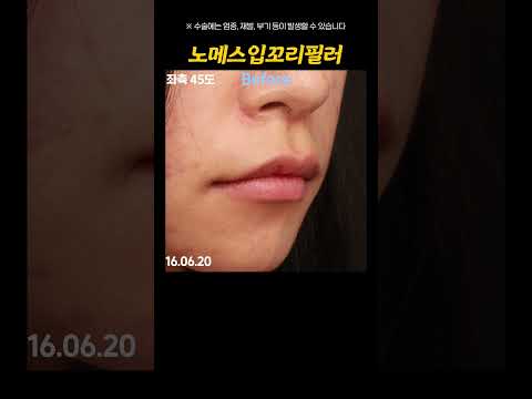 예쁜 미소로 바뀌고 싶다면? 로렌의 노메스 입꼬리 필러💗