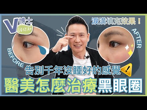 告別千年沒睡好的感覺！醫美怎麼治療黑眼圈？【V博士話你知】