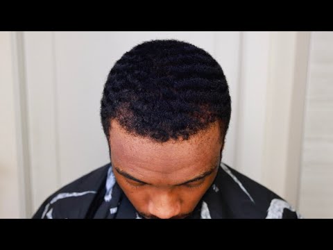 I cut off my hair transplant