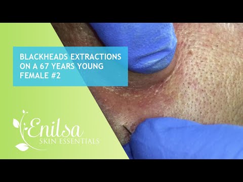 Blackheads Extractions on a 67 Years Young Female #2