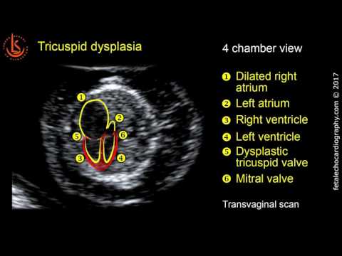 Fetal echocardiography at 11-13 weeks: Tricuspid Valve Dysplasia with Severe Tricuspid Regurgitation