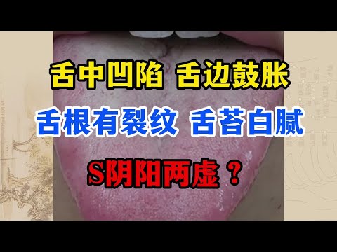 舌中凹陷，舌边鼓胀，舌根有裂纹，这是阴阳两虚了吗？