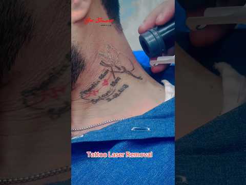 Tattoo Laser Removal #getsmarthairclub #skincare #viralvideo