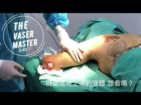 The Vaser master 7威塑大師第七集 溶脂是否一定要抽呢？