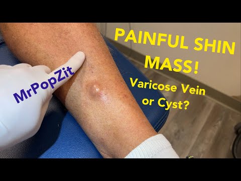 Painful pretibial mass pushing against tight skin! Watch out for varicose veins in this area!