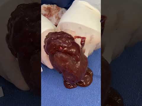 Case of the Chocolate Breast Implant