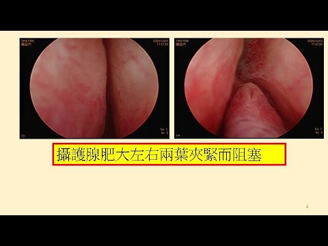 我是不是攝護腺有問題了？－林文州20230127