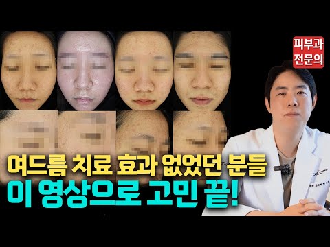 여드름치료 받으면서 피부과에 헛돈 쓰신 분들 무조건 보세요 / 피부과 여드름 치료의 모든 것