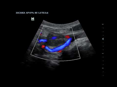 Vagus Nerve Paraganglioma between internal and external carotid artery