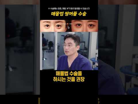 매몰법 쌍꺼풀 수술 이런분들 추천 드립니다