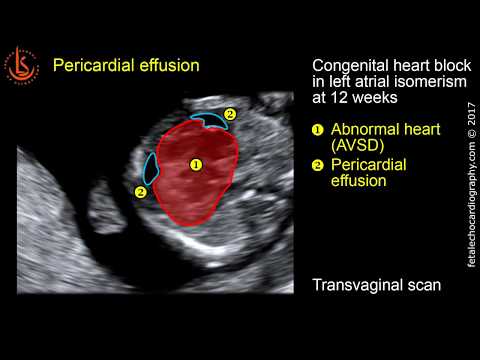 Fetal echocardiography at 11-13 weeks: Pericardial Effusion