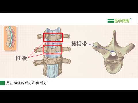 胸椎黄韧带骨化导致的胸椎管狭窄，常用哪种手术方式？手术是如何进行的？