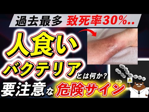 放置厳禁！知らないと後悔する「人食いバクテリア」が引き起こす体の変化。超意外な危険サインとは。感染が急増している理由とは。医師が徹底解説！