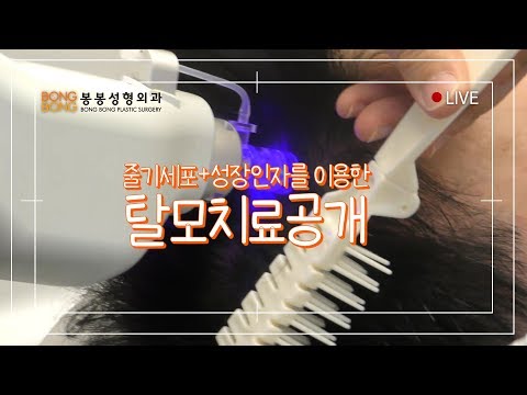 탈모의 근본적인 해결책! 줄기세포+성장인자를 이용한 탈모치료