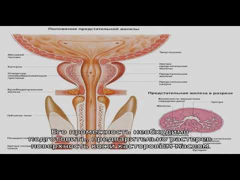 Массаж простаты при лечении аденомы