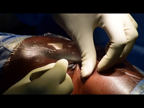 Episode 1 - 1K1M Project (Nigerian Heart Surgery)