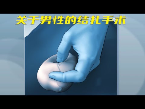 一分钟带你了解男性结扎全过程