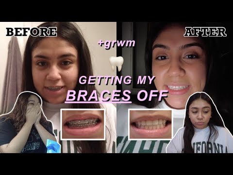 GETTING MY BRACES OFF!! 🤭🥲 *2.5 years later*