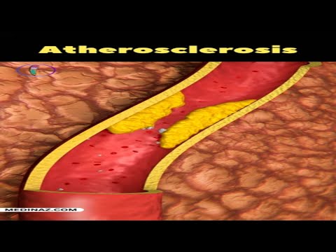 Atherosclerosis | What is atherosclerosis? Heart attack - The real reason #healthtips #heartattack