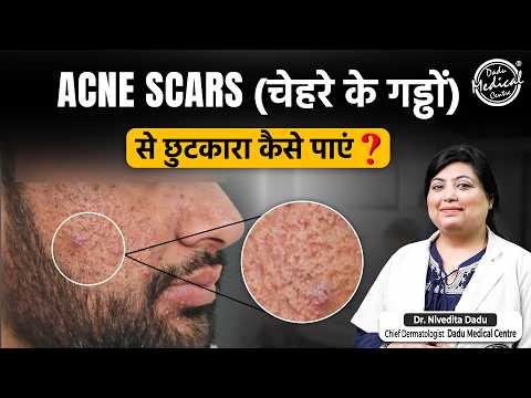 How to Treat Acne Scars? | Acne Scar Treatments: Laser, MNRF, PRP | Patient's Journey at DMC