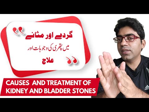 Causes & Treatment of Kidney & Bladder Stones#kidneystones#bladderstones #lithotripsy #pcnl