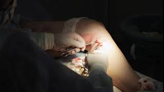 Phlebectomy: Varicose Vein Surgery