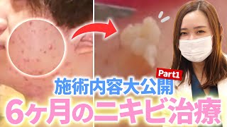 【ニキビ治療】患者様密着part.1☆カウンセリング～治療までの施術内容を大公開☆【ニキビ跡・サリチル酸ピーリング・コメド・アグネス・ジェネシス・エクセルV・イオン導入】