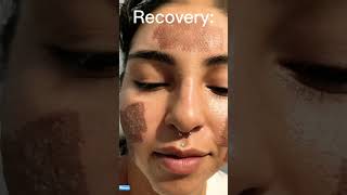 We Treated Her Acne in just One Day! 😱#skincare #beauty #shorts #laser