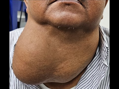 甲狀腺手術後的雙側聲帶麻痹 bilateral vocal palsy after thyroid surgery