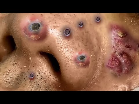 Removing Blackheads Deep Black  Blackheads and Pimples