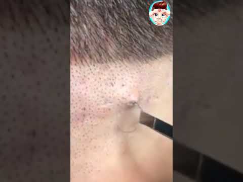 Big Cystic Acne Blackheads Extraction Blackheads & Milia, Whiteheads Removal Pimple Popping