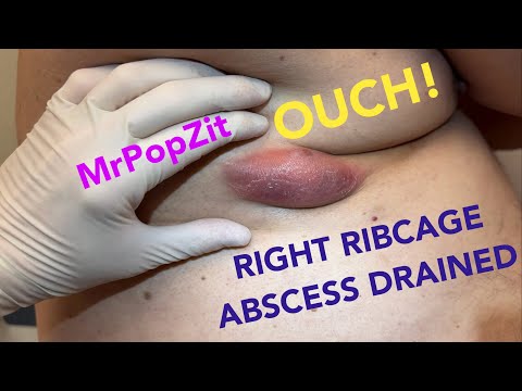 Giant ribcage abscess. Very tender fluid pocket drained, flushed, and packed, with 6 day follow up.