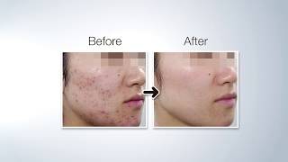 Ciao Beauty医美诊所PRP自体血清回春术流程- 安全可靠 PRP treatment by Ciao Beauty Cosmetic Clinic