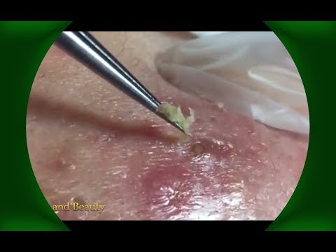 Best Pimple Popping Videos - Blackheads 2019 #13