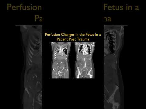 Perfusion Changes in the Fetus in a Patient Post Trauma