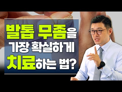 한번 걸리면 불치? ‘발톱 무좀!’ 확실하게 치료하려면? - 고제익의 비아그라보다 달리기 #41