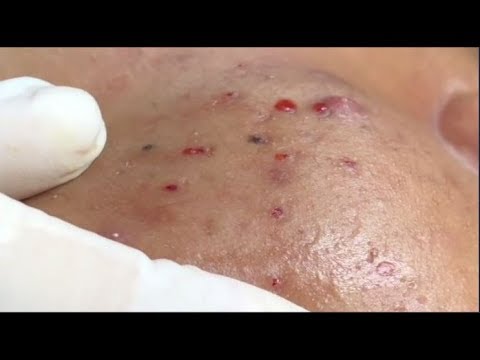 Big Acne Removal, Skill Acnes Remove 2019, Milia