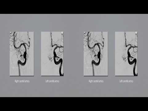 Bifrontal approach for clip ligation of bilateral ethmoidal dural arteriovenous fistulas