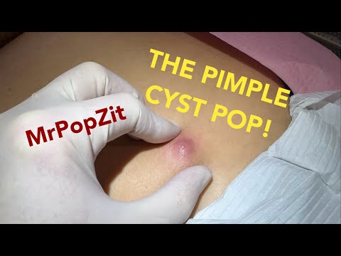 What looked like a large pimple was much more! The pimple cyst pop!