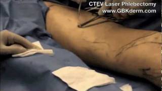 CTEV Laser Vein Removal | Laser Phlebectomy | San Diego