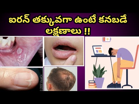 Iron Deficiency symptoms in Telugu| ఐరన్ తక్కువగా ఉంటే కనబడే లక్షణాలు.