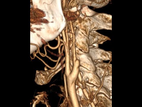 Case of internal carotid artery dissection MRI, CTA and Duplex Scanning images and videos