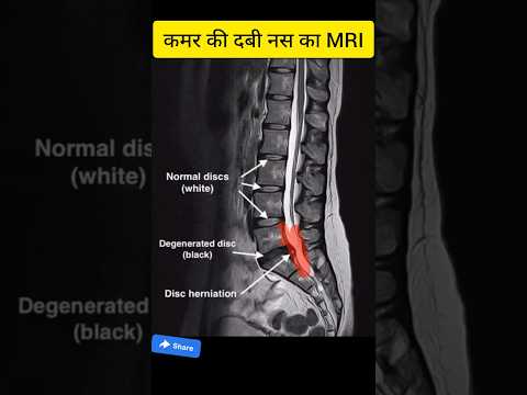 कमर की दबी नस का MRI