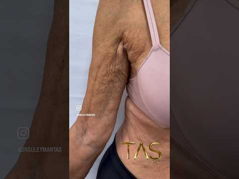 #scarlessarmlift is definitely one of the best innovations in plastic surgery field✨ #drsuleymantas