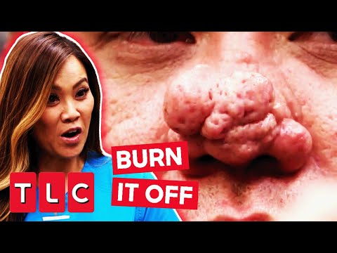 Dr. Lee BURNS OFF Man's Hardened Nose | Dr. Pimple Popper: This Is Zit!