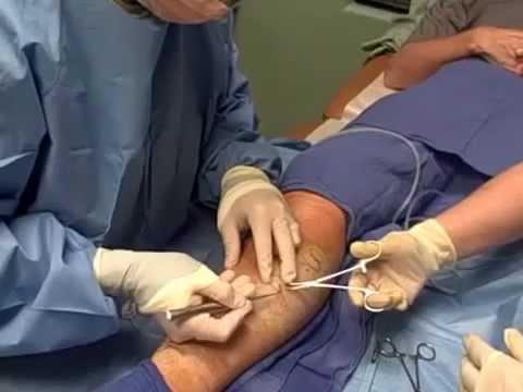 Ambulatory Phlebectomy Vein Removal - Skinovative and Center for Venous Disease