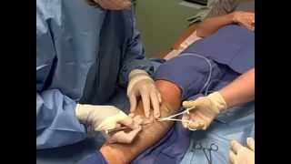 Ambulatory Phlebectomy Vein Removal - Skinovative and Center for Venous Disease